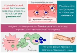 Детальніше про статтю Красный плоский лишай