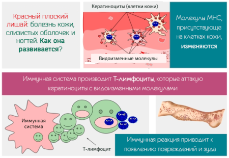 Read more about the article Красный плоский лишай
