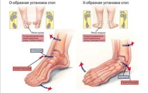 Детальніше про статтю Что происходит при плоскостопии?