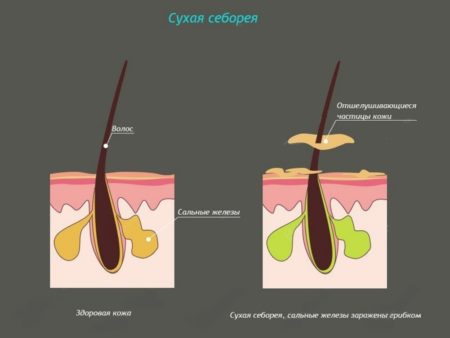 Ви зараз переглядаєте Себорея. Угри Акне