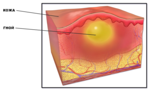 Детальніше про статтю Фурункул