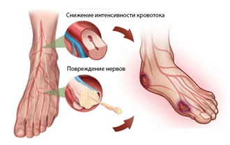 Детальніше про статтю Диабетическая стопа