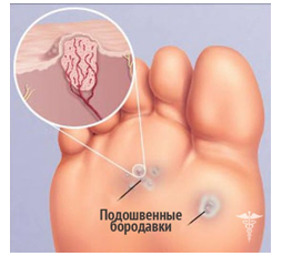 Детальніше про статтю Подошвенные бородавки