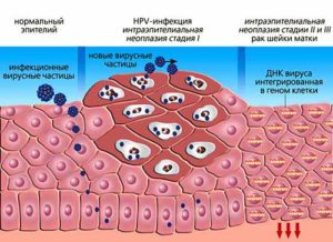 Детальніше про статтю Широкие кондиломы