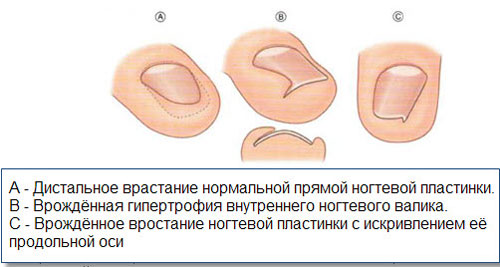 vrostanie-nogtya